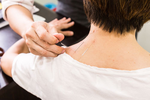 acupuncture for chronic pain management definition